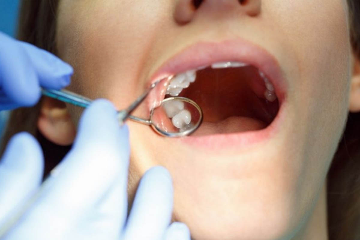 gd salud extracción tercer molar imagen
