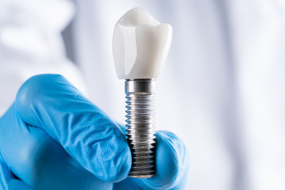 especialidad imagen implantes dentales odontologia centro de salud gd salud
